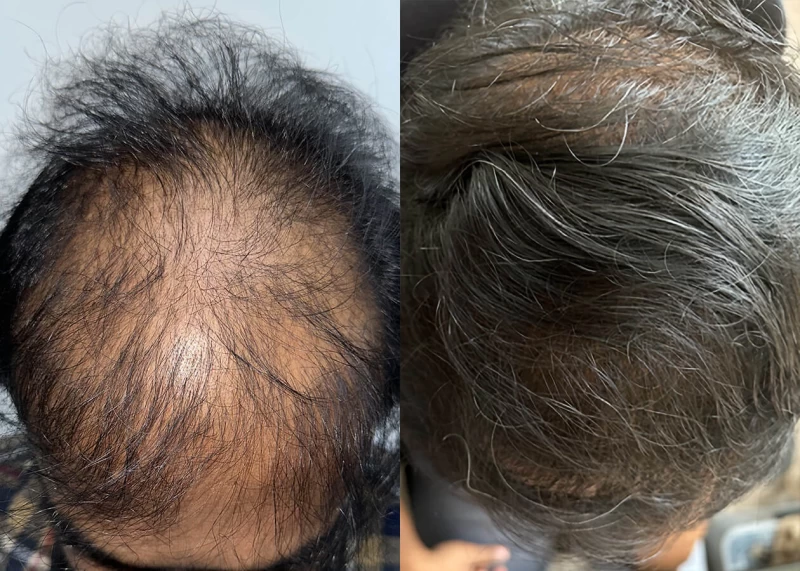 Patient p663 hair transplant before and after tilt view