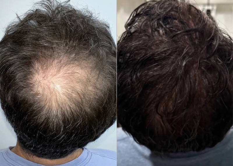Patient 664 Hair Transplant Before and After