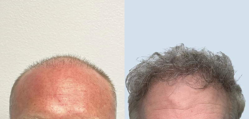 Patient 665 Hair Transplant Before and After