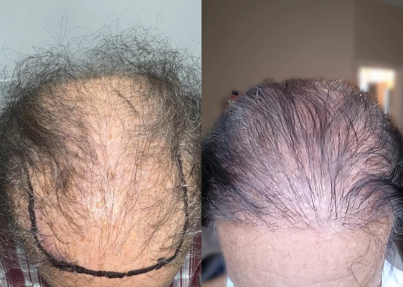 Patient 666 Hair Transplant Before and After
