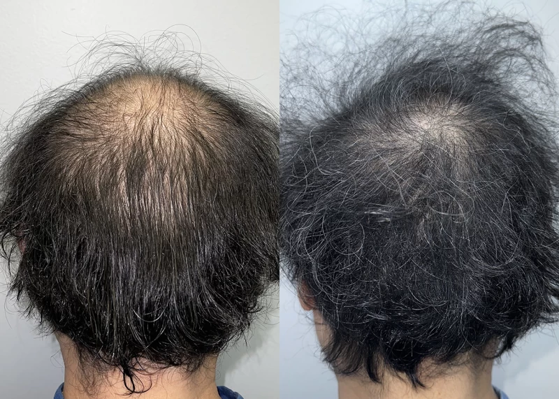 Patient p667 hair transplant before and after crown view