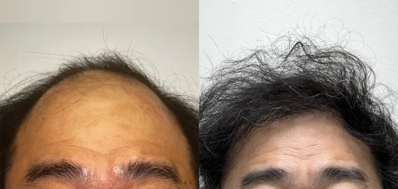 Patient 667 Hair Transplant Before and After