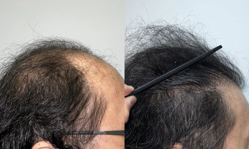 Patient p667 hair transplant before and after right view