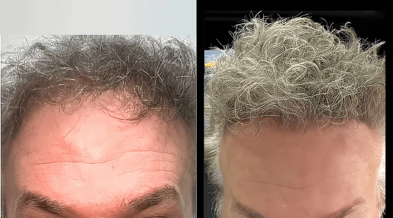 Patient 668 Hair Transplant Before and After