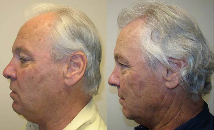 Patient 66 Hair Transplant Before and After
