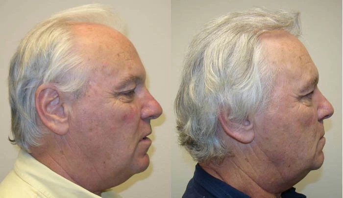 Patient p66 hair transplant before and after right view