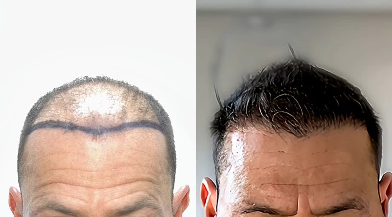Patient 670 Hair Transplant Before and After