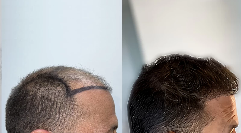 Patient p670 hair transplant before and after right view
