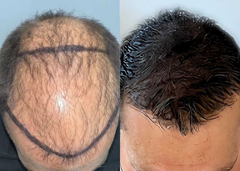 Patient p670 hair transplant before and after tilt view