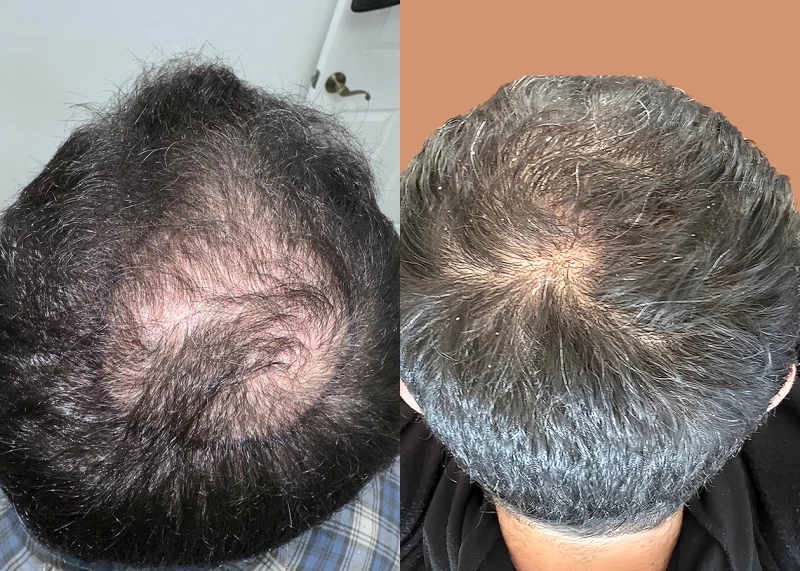 Patient 671 Hair Transplant Before and After