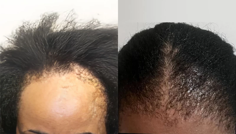 Patient 673 Hair Transplant Before and After