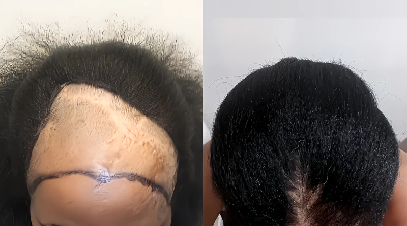 Patient p673 hair transplant before and after tilt view