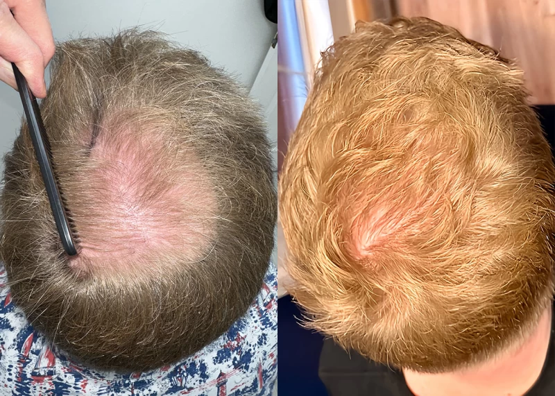 Patient p675 hair transplant before and after crown view