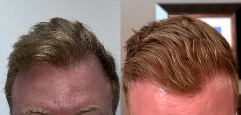 Patient 675 Hair Transplant Before and After