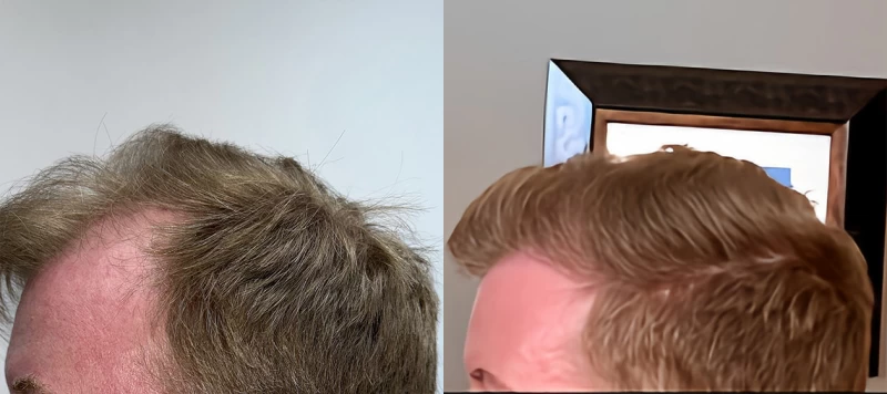 Patient p675 hair transplant before and after left view