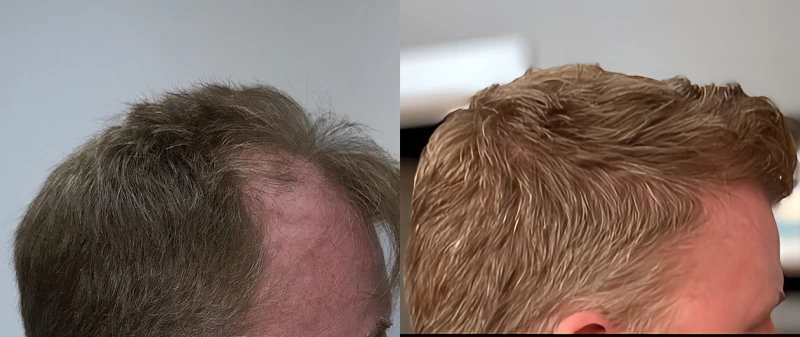 Patient p675 hair transplant before and after right view