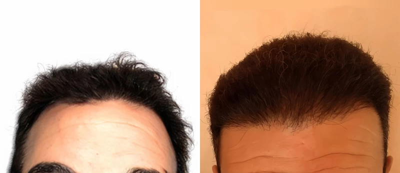 Patient 676 Hair Transplant Before and After