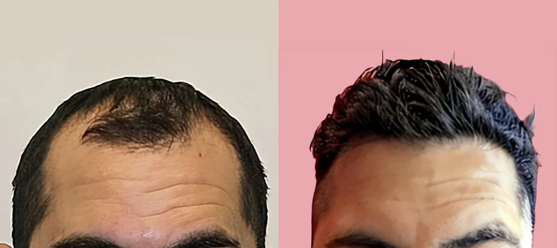 Patient 677 Hair Transplant Before and After