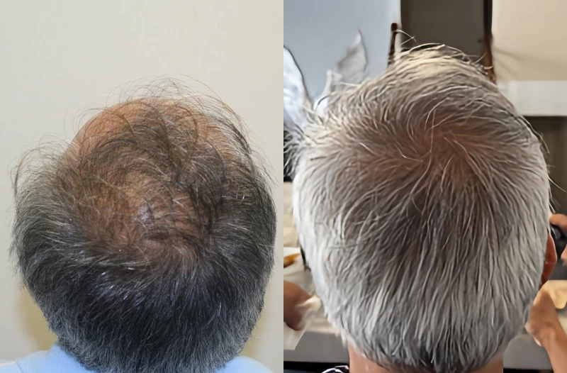 Patient p678 hair transplant before and after crown view