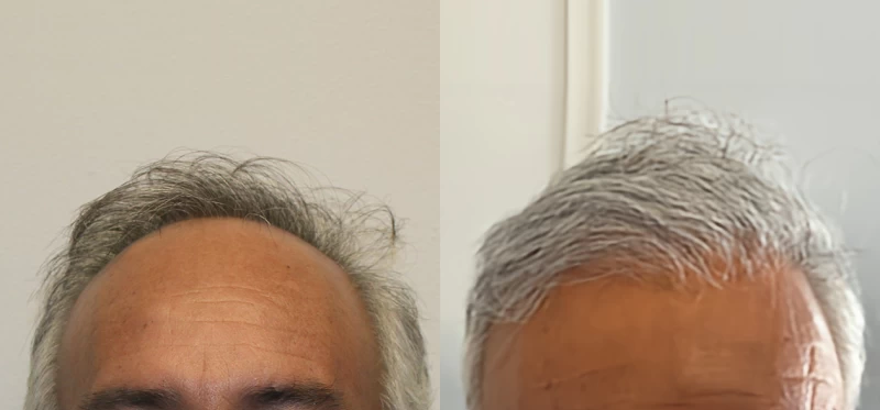 Patient 678 Hair Transplant Before and After