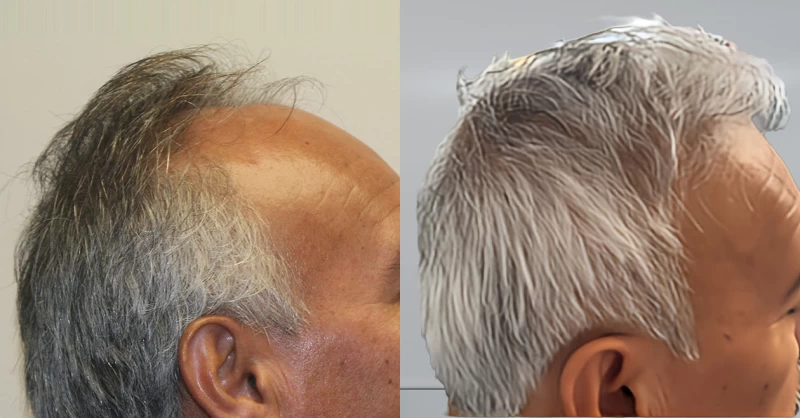Patient p678 hair transplant before and after right view
