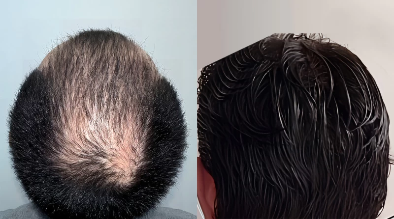 Patient p679 hair transplant before and after crown view