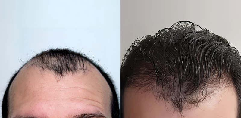 Patient 679 Hair Transplant Before and After
