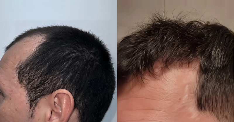Patient p679 hair transplant before and after left view