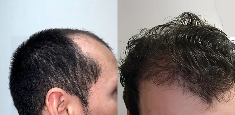 Patient p679 hair transplant before and after right view