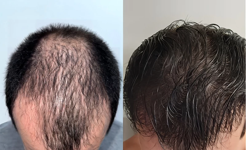 Patient p679 hair transplant before and after tilt view