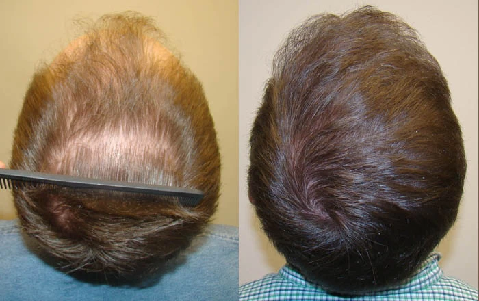 Patient p67 hair transplant before and after crown view