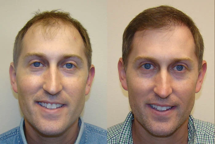 Mike Hair Transplant Before and After