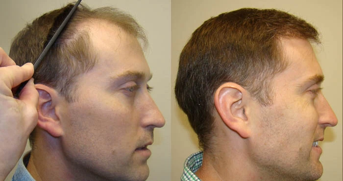 Patient p67 hair transplant before and after left view