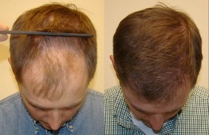 Patient p67 hair transplant before and after tilt view