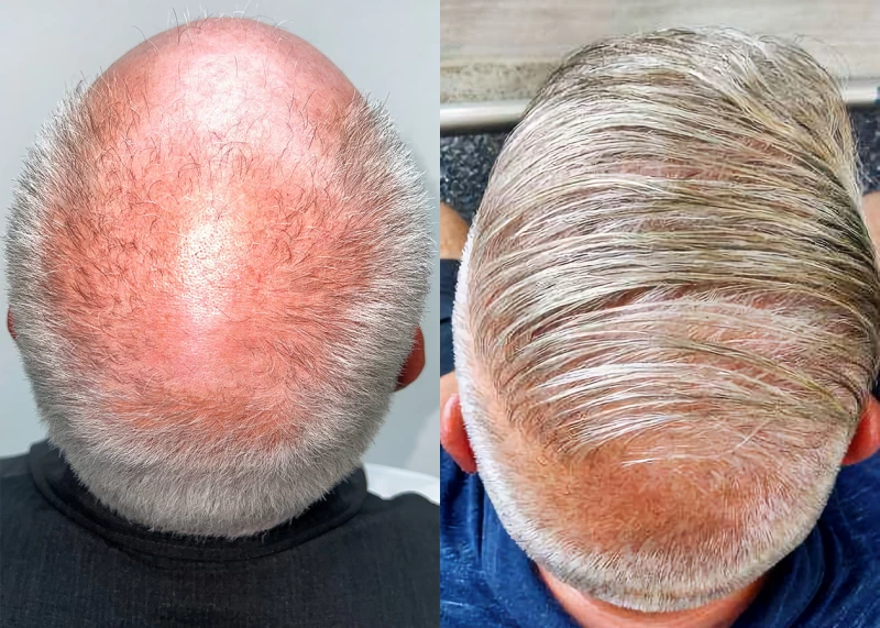 Patient p681 hair transplant before and after crown view
