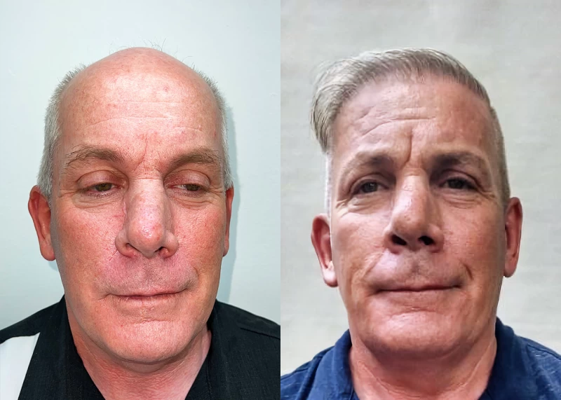 Patient 681 Hair Transplant Before and After