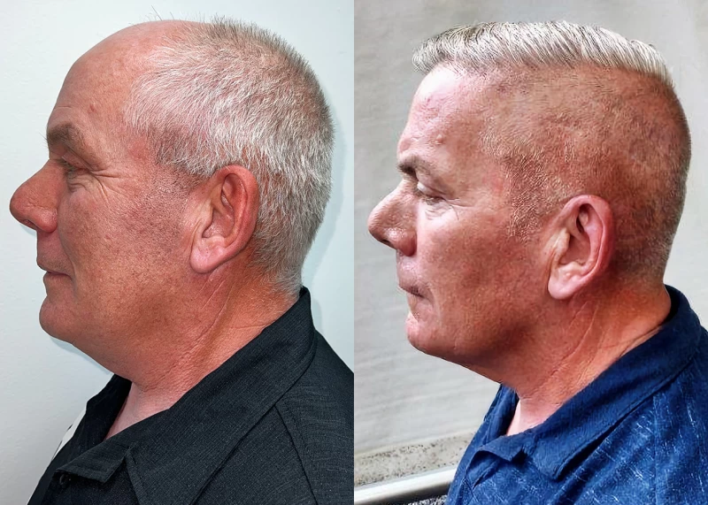 Patient p681 hair transplant before and after left view