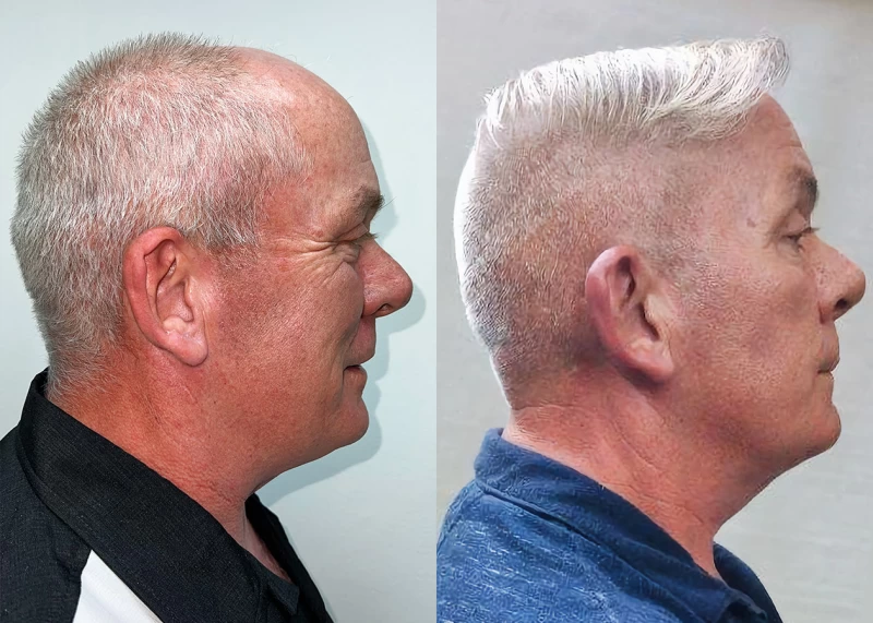 Patient p681 hair transplant before and after right view