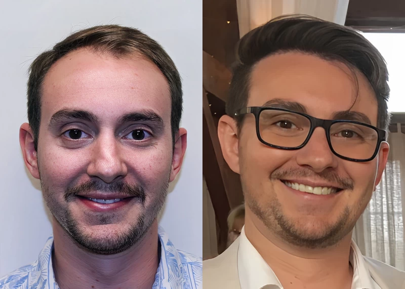 Patient 682 Hair Transplant Before and After