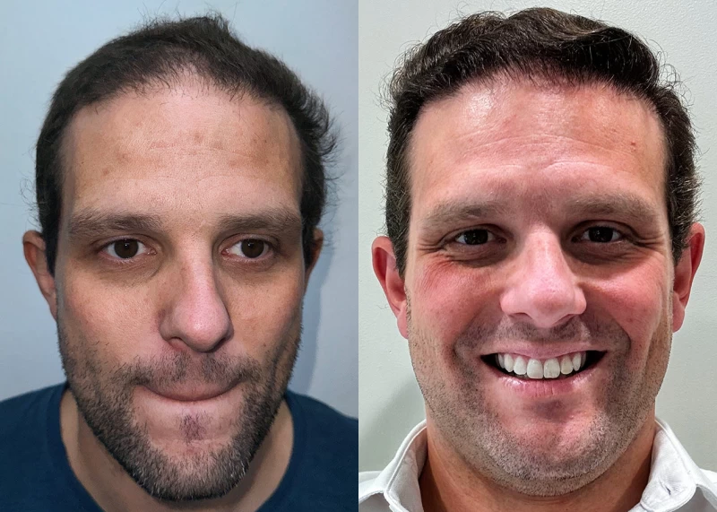 Patient 683 Hair Transplant Before and After