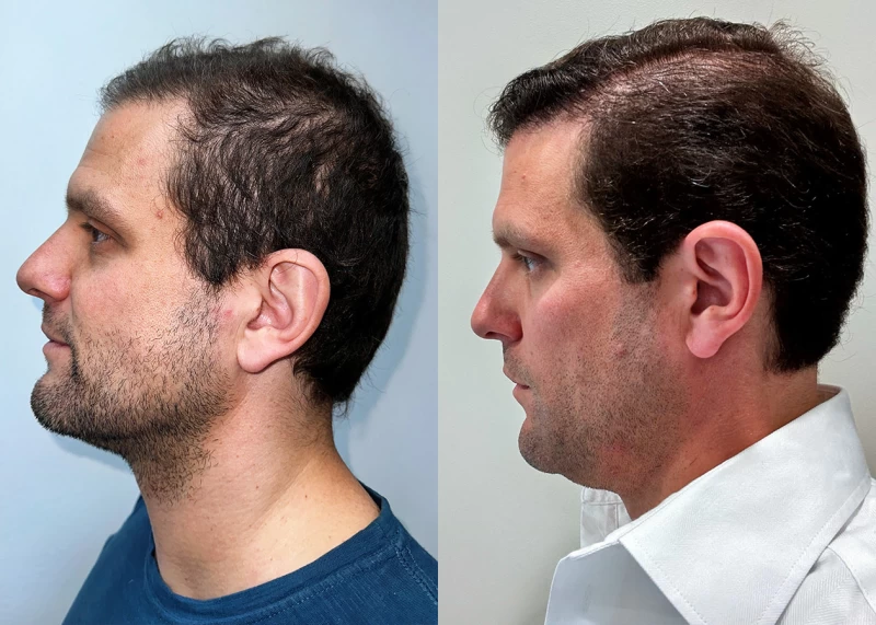 Patient p683 hair transplant before and after left view