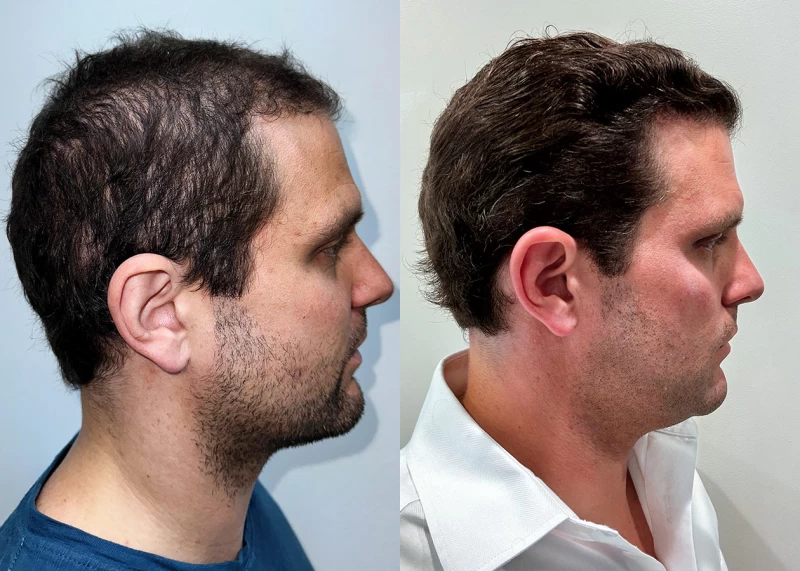 Patient p683 hair transplant before and after right view