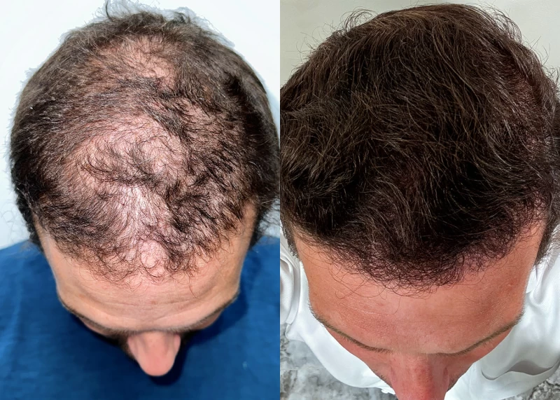 Patient p683 hair transplant before and after tilt view