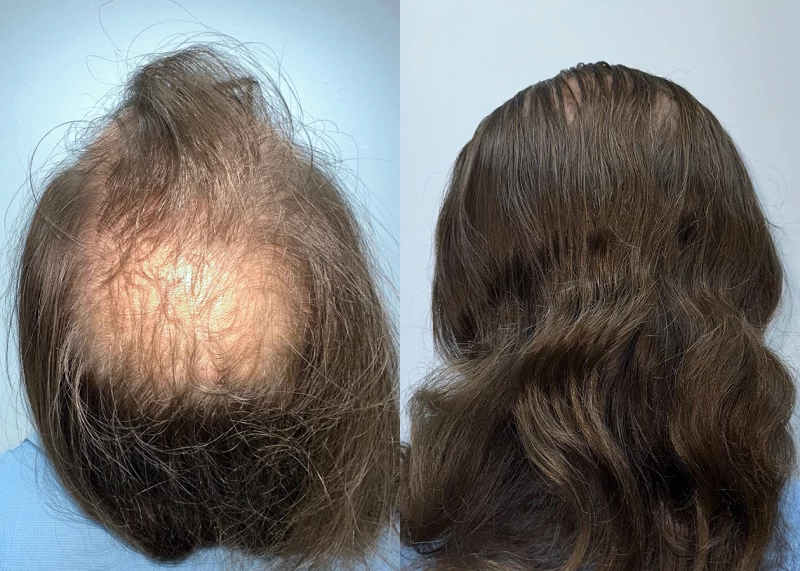 Patient p685 hair transplant before and after crown view