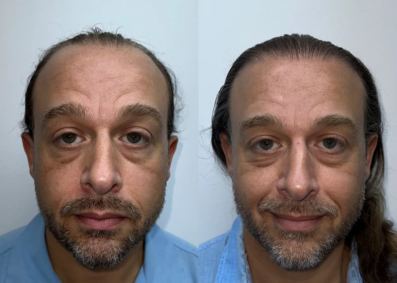 Matt Hair Transplant Before and After
