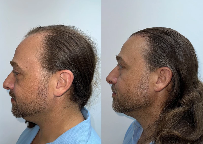 Patient p685 hair transplant before and after left view
