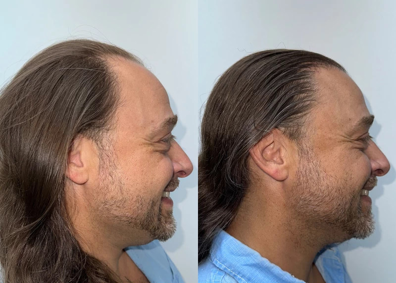 Patient p685 hair transplant before and after right view