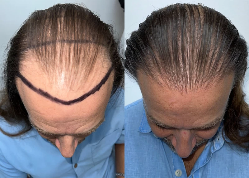 Patient p685 hair transplant before and after tilt view