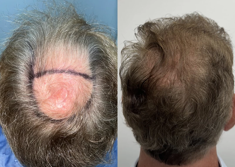Patient p686 hair transplant before and after crown view