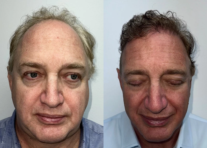 Jeff  Hair Transplant Before and After